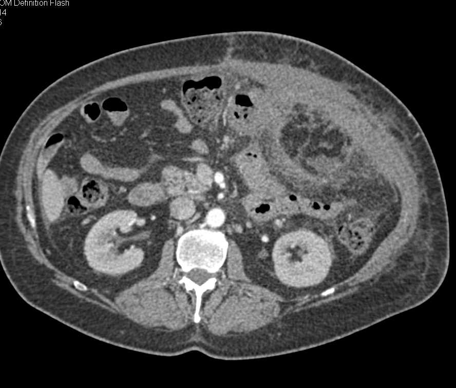 Mesentery with Inflammation Involving the Left Side of Abdomen - CTisus CT Scan