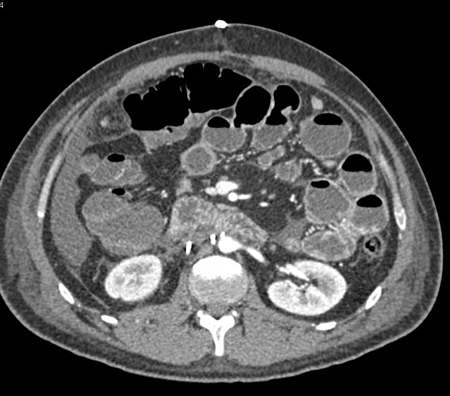 Post Op Small Bowel Partial Obstruction - Small Bowel Case Studies