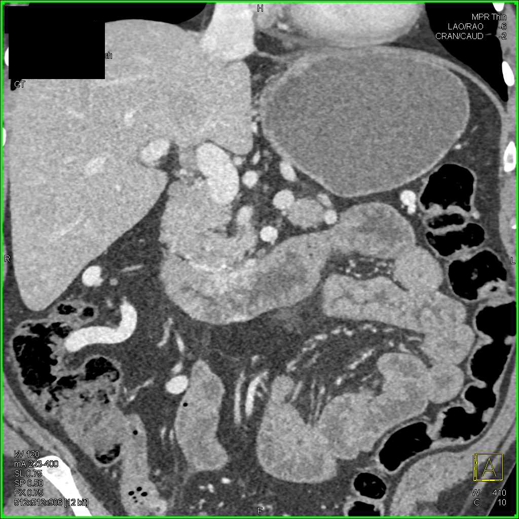 Adenocarcinoma in the Third Portion of the Duodenum - CTisus CT Scan