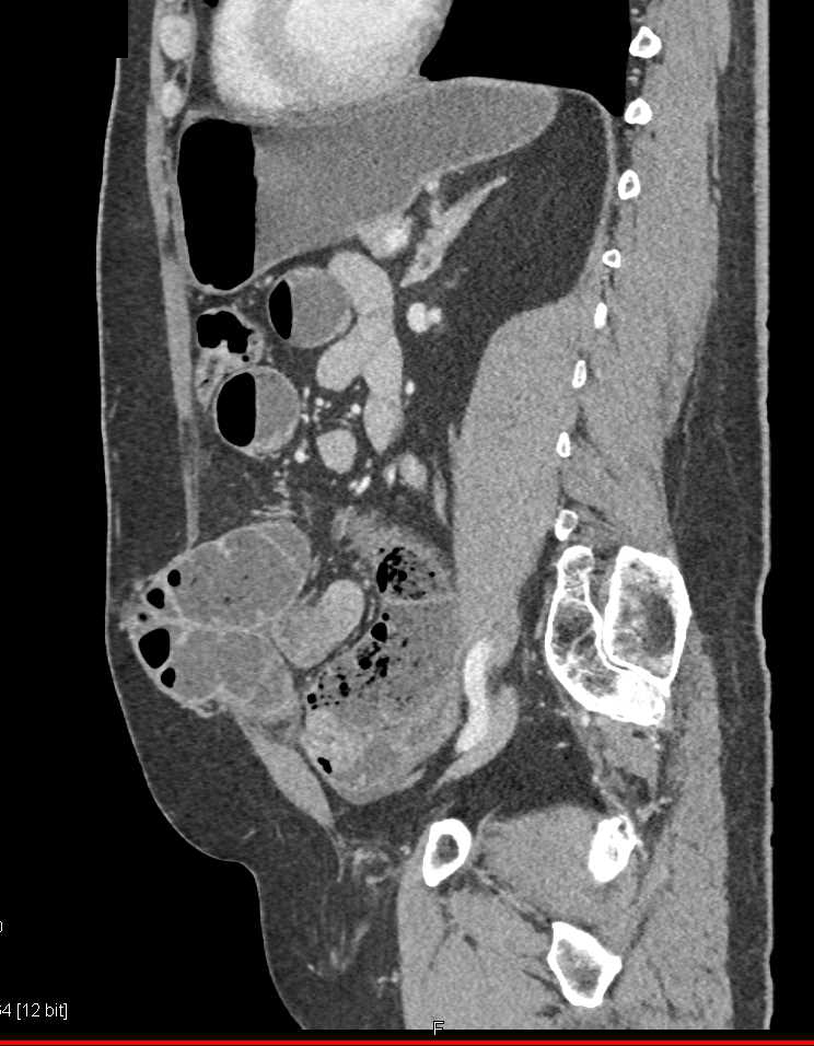 Small Bowel Obstruction due to Incisional Hernia Site Nicely Shown on Oblique Views - CTisus CT Scan