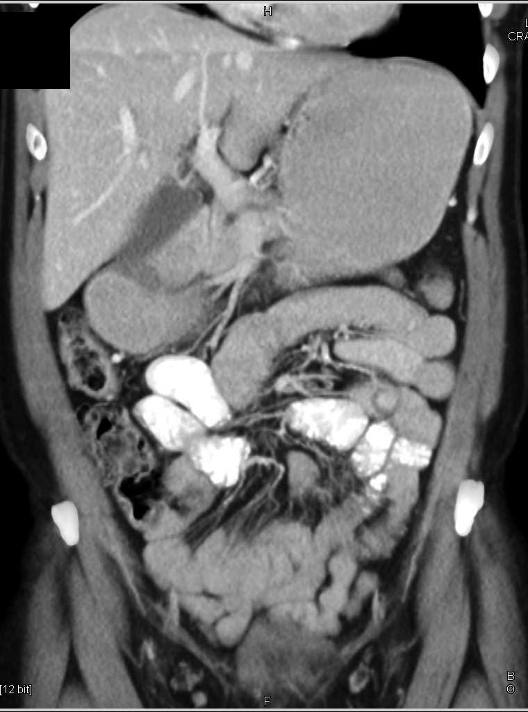 Obstruction Duodenum by Bands - CTisus CT Scan
