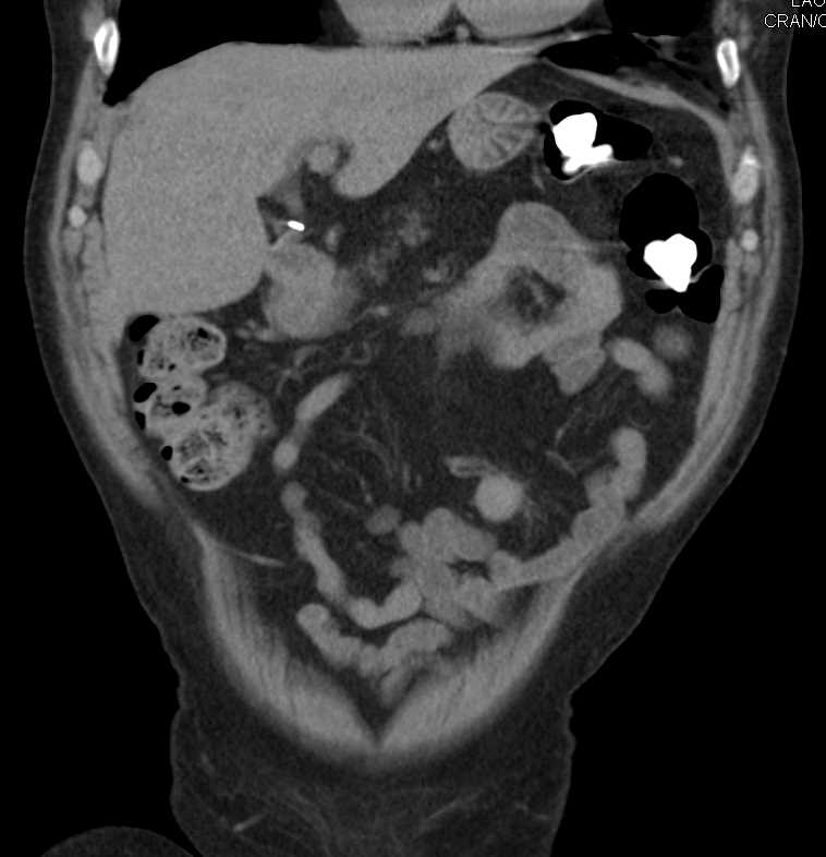 Active Bleed in Jejunal Loop in Patient with Intraductal Papillary Mucinous Neoplasm (IPMN) - CTisus CT Scan