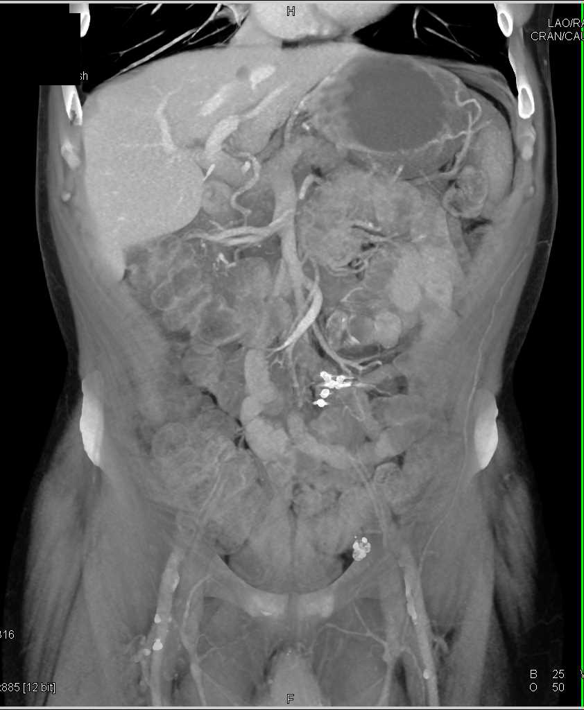 Active Bleed in Jejunal Loop in Patient Seen on CTA - CTisus CT Scan