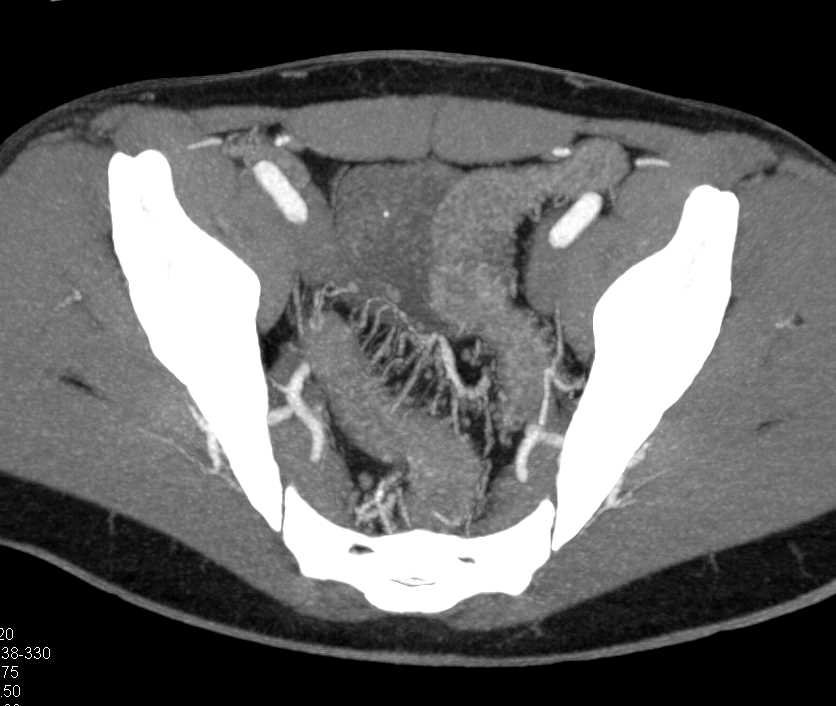 Crohn's Disease Small Bowel - CTisus CT Scan