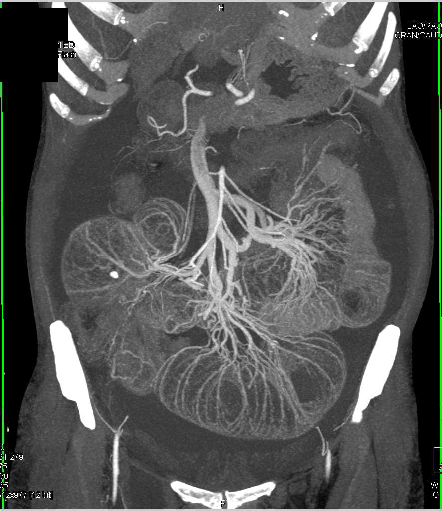 Small Bowel Obstruction with Dilated Small Bowel - CTisus CT Scan