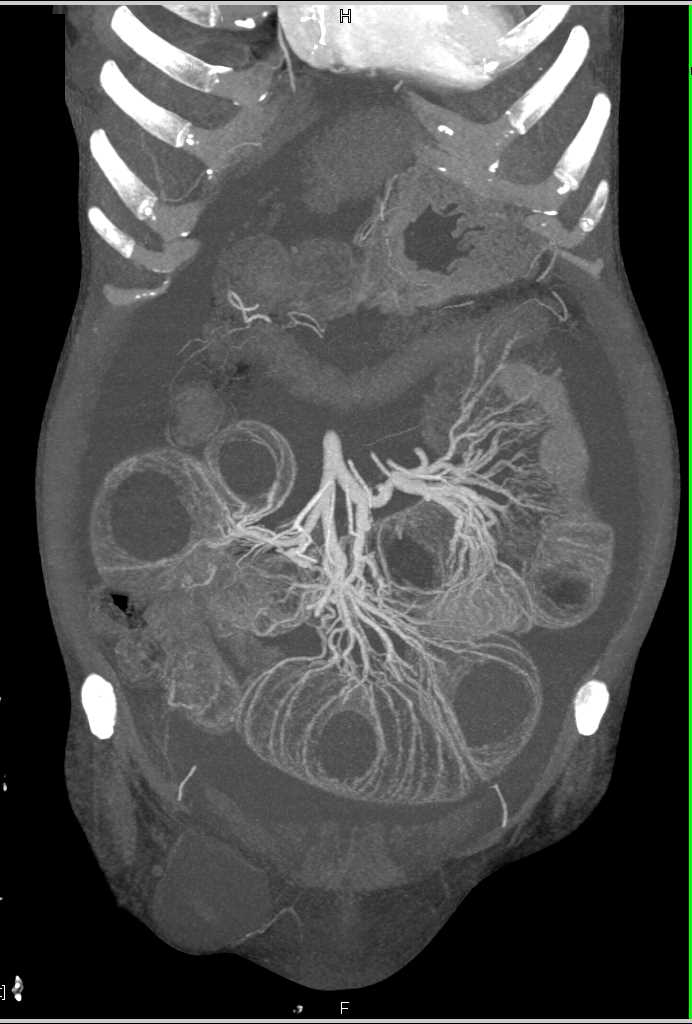 Small Bowel Obstruction with Dilated Small Bowel and Prominent Vasa Recta - CTisus CT Scan