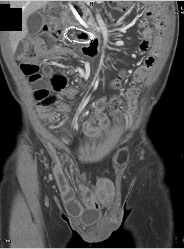 Small Bowel Obstruction (SBO) due to Hernia of Small Bowel Through Inguinal Ring on the Right - CTisus CT Scan