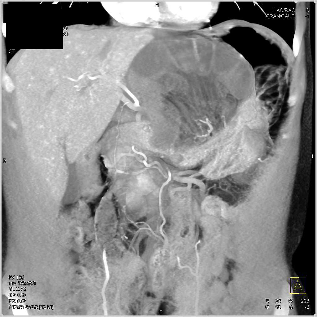 Internal Hernia with Midgut Volvulus with Small Bowel Obstruction and Ischemic Bowel - CTisus CT Scan