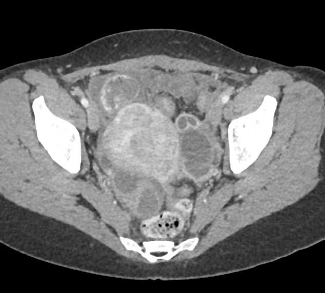 Small Bowel Obstruction (SBO) due to Distal Small Bowel Obstruction - CTisus CT Scan