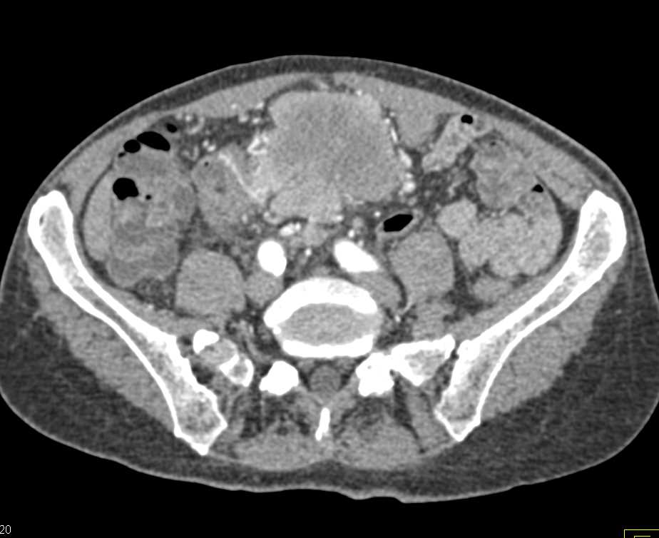 Liver Laceration S/P Biopsy in Patient with a Small Bowel GIST Tumor - CTisus CT Scan