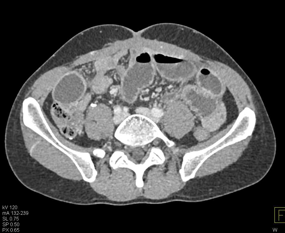 Small Bowel Obstruction due to Adhesions - CTisus CT Scan