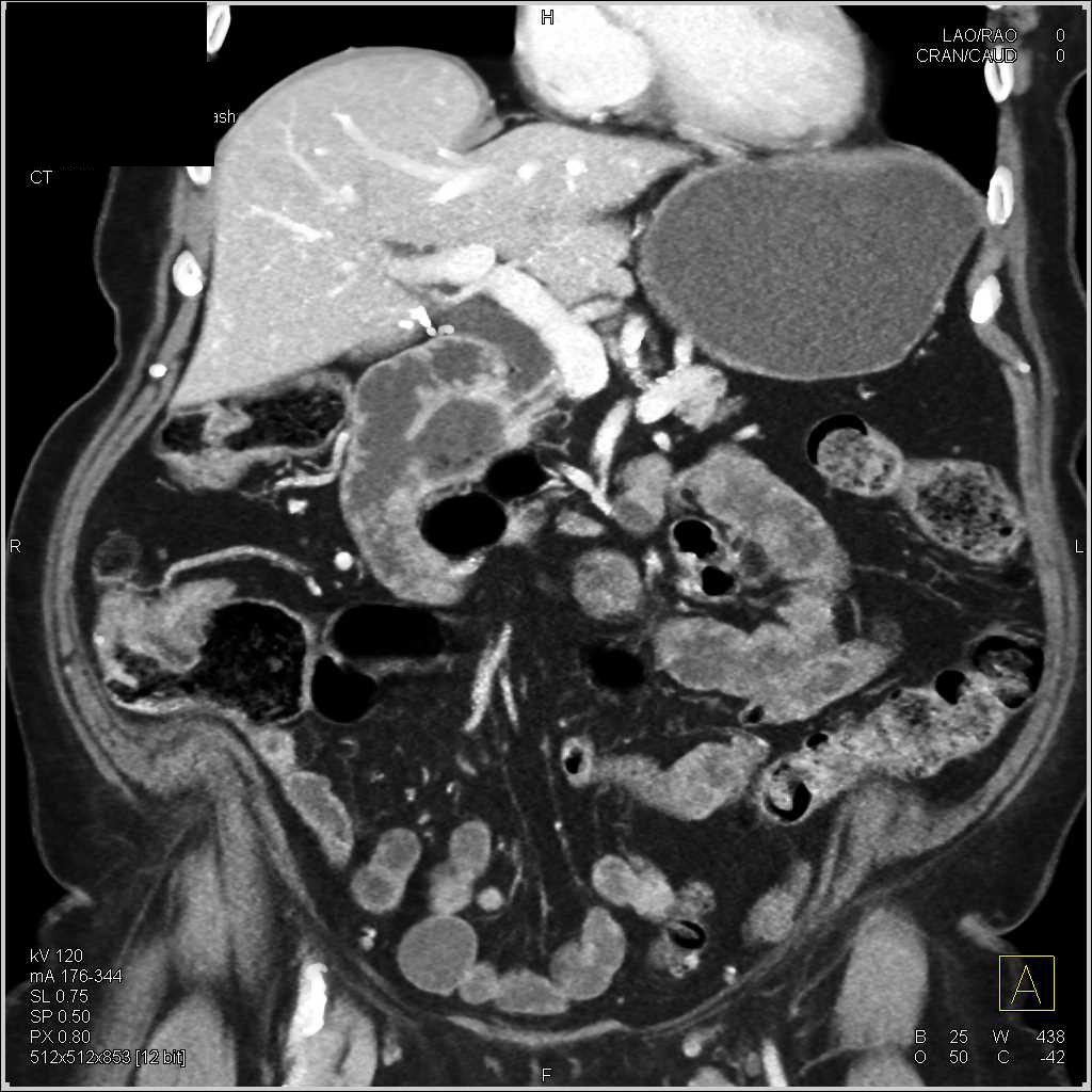 Duodenal Diverticulum Obstructs the Common Bile Duct in 3D - CTisus CT Scan