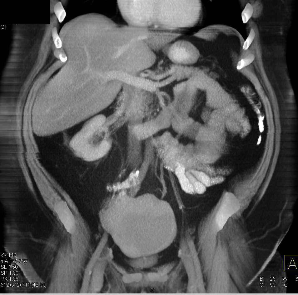 Small Bowel GIST Tumor - CTisus CT Scan