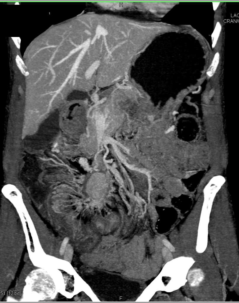 Metastatic Carcinoid Tumor to the Liver and Bowel and Mesentery - CTisus CT Scan