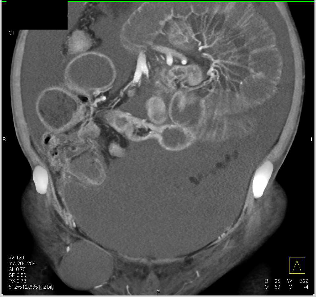 Midgut Volvulus with Ascites - CTisus CT Scan