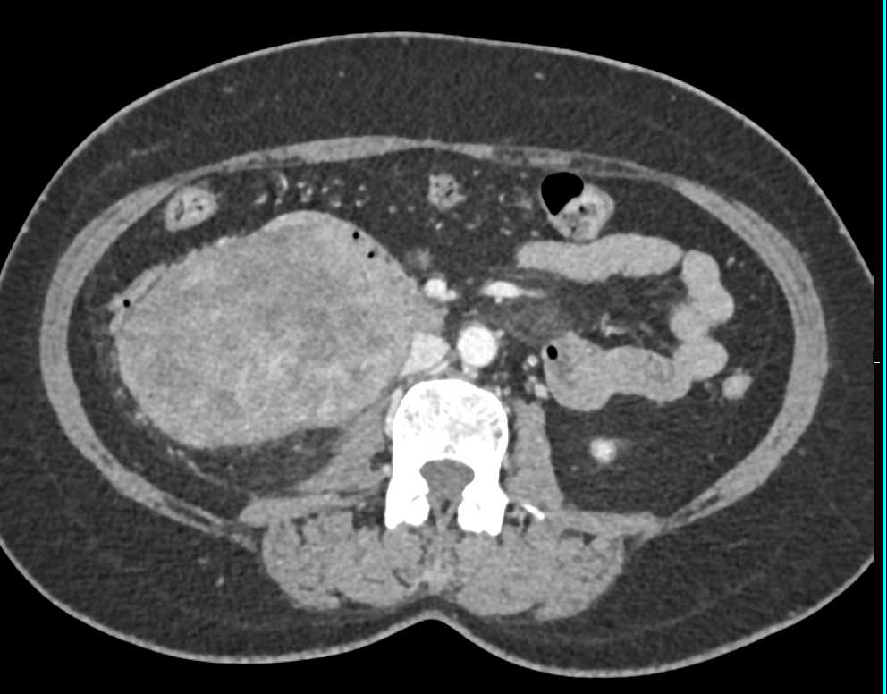 Duodenal GIST Tumor - CTisus CT Scan