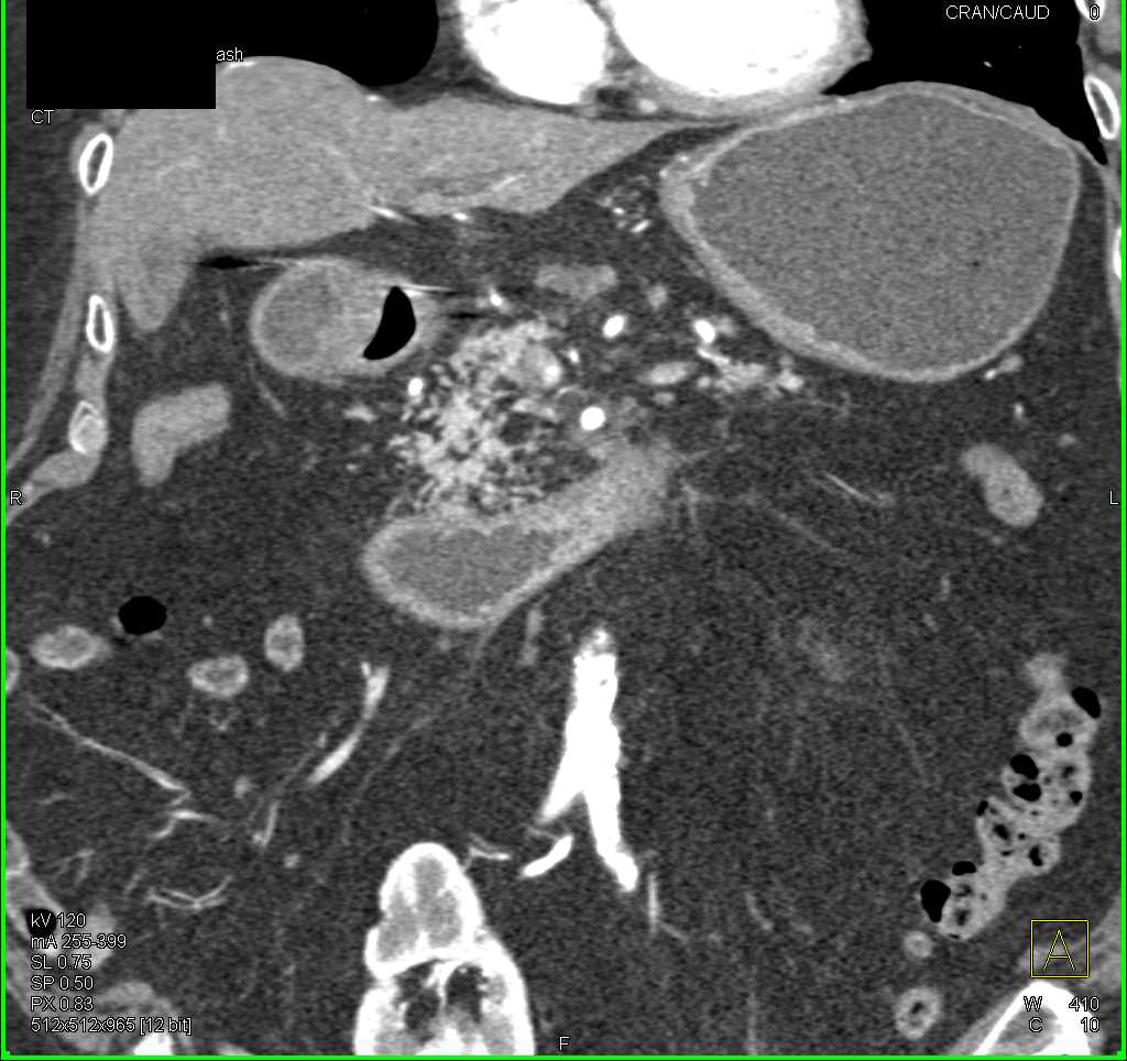 Duodenal Carcinoma with Small Bowel Obstruction - CTisus CT Scan