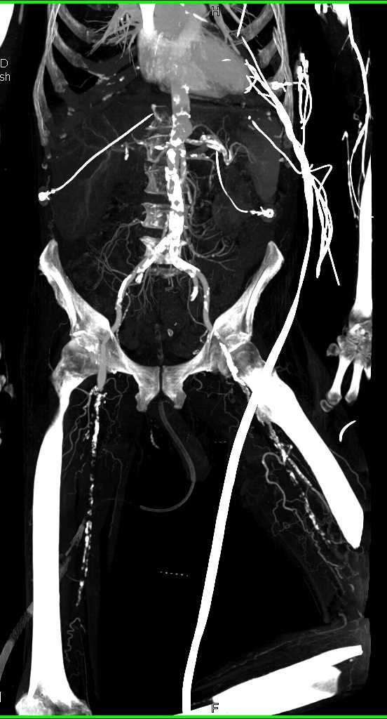 Duodenal GIST Tumor - CTisus CT Scan