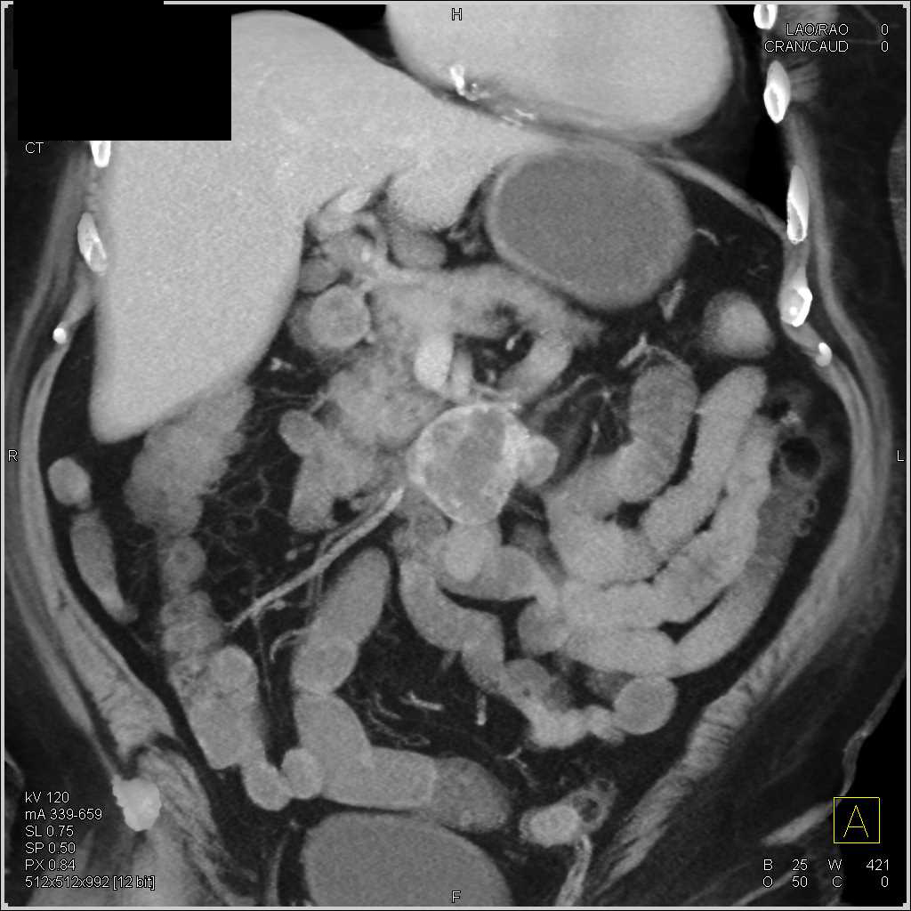 Duodenal GIST Tumor - CTisus CT Scan