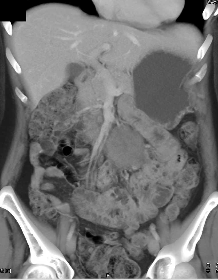 Mesenteric Cyst Left Lower Quadrant - CTisus CT Scan