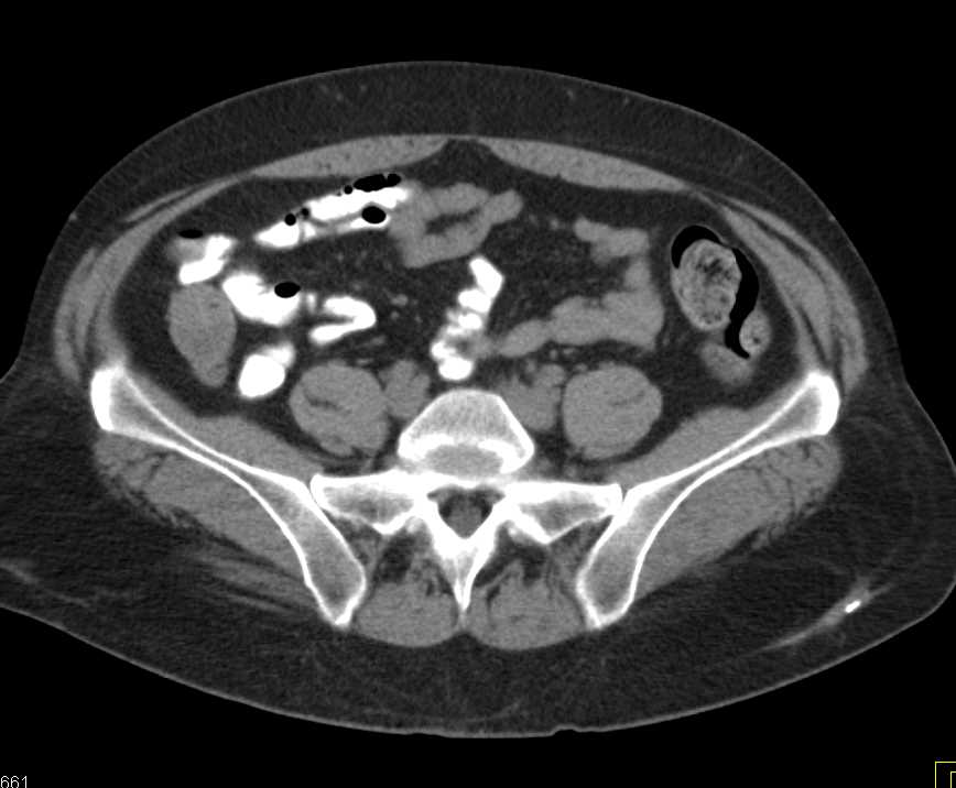 Crohn's Disease Small Bowel - CTisus CT Scan