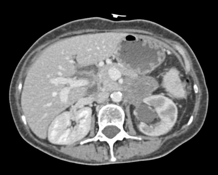 Incidental Small Bowel Lipoma in Patient with Pancreatic Cancer - CTisus CT Scan