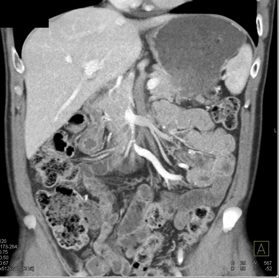 Unsuspected Superior Mesenteric Artery (SMA) Occlusion with Vasculitis Like Appearance - CTisus CT Scan