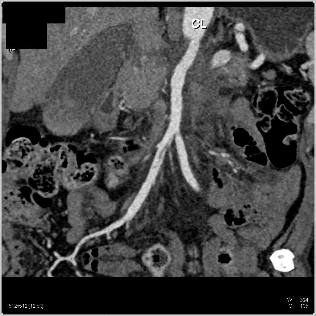 Unsuspected Superior Mesenteric Artery (SMA) Occlusion with Vasculitis Like Appearance - CTisus CT Scan