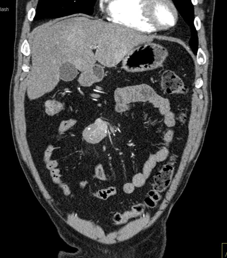 Carcinoid Tumor Mesentery with Liver Metastases - CTisus CT Scan