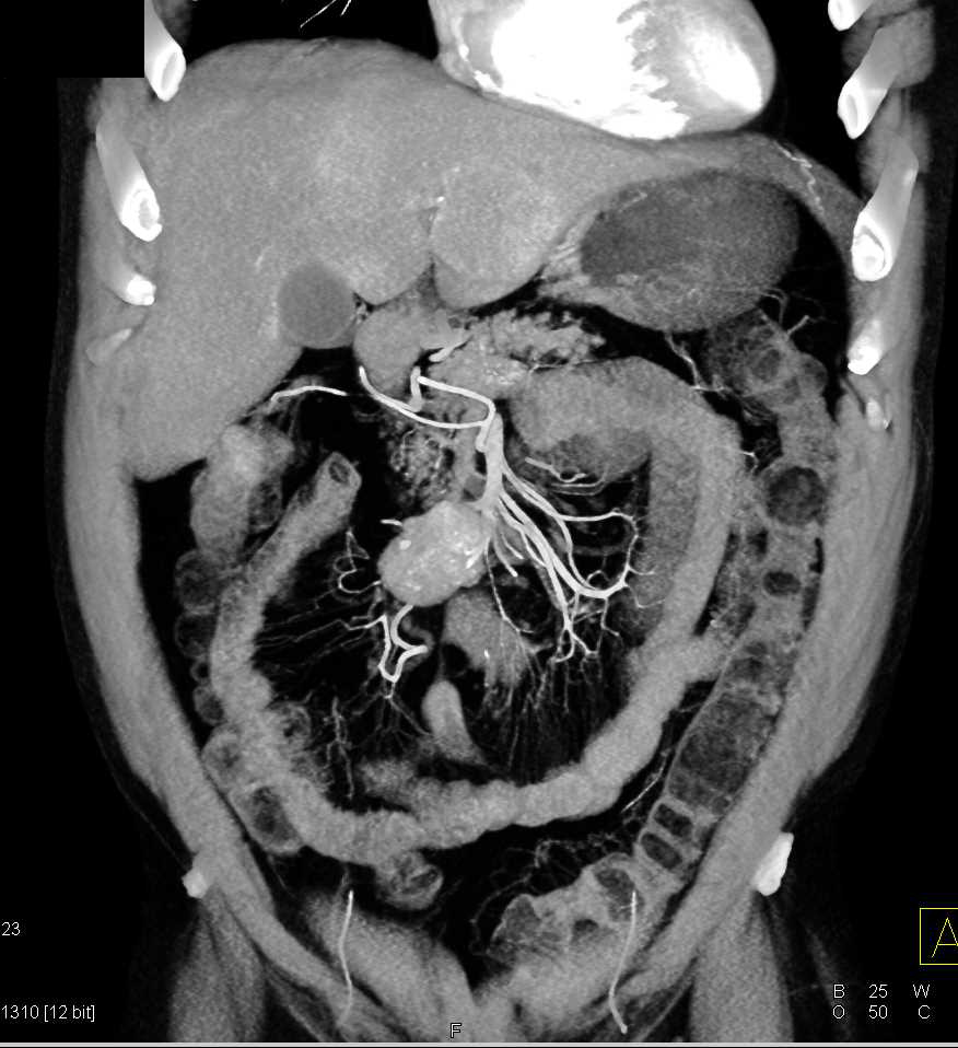 Carcinoid Tumor in the Root of the Mesentery - CTisus CT Scan