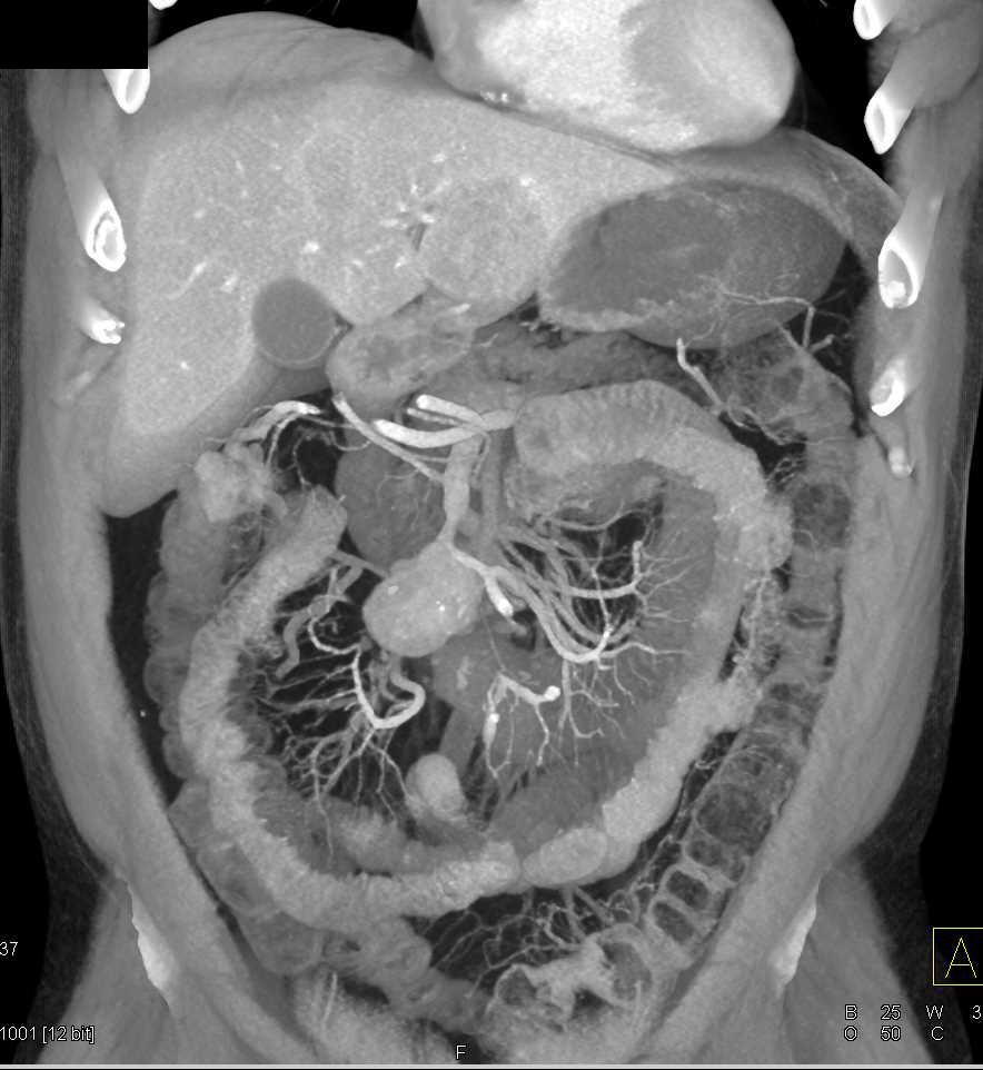 Carcinoid Tumor in the Root of the Mesentery with Liver Metastases - CTisus CT Scan