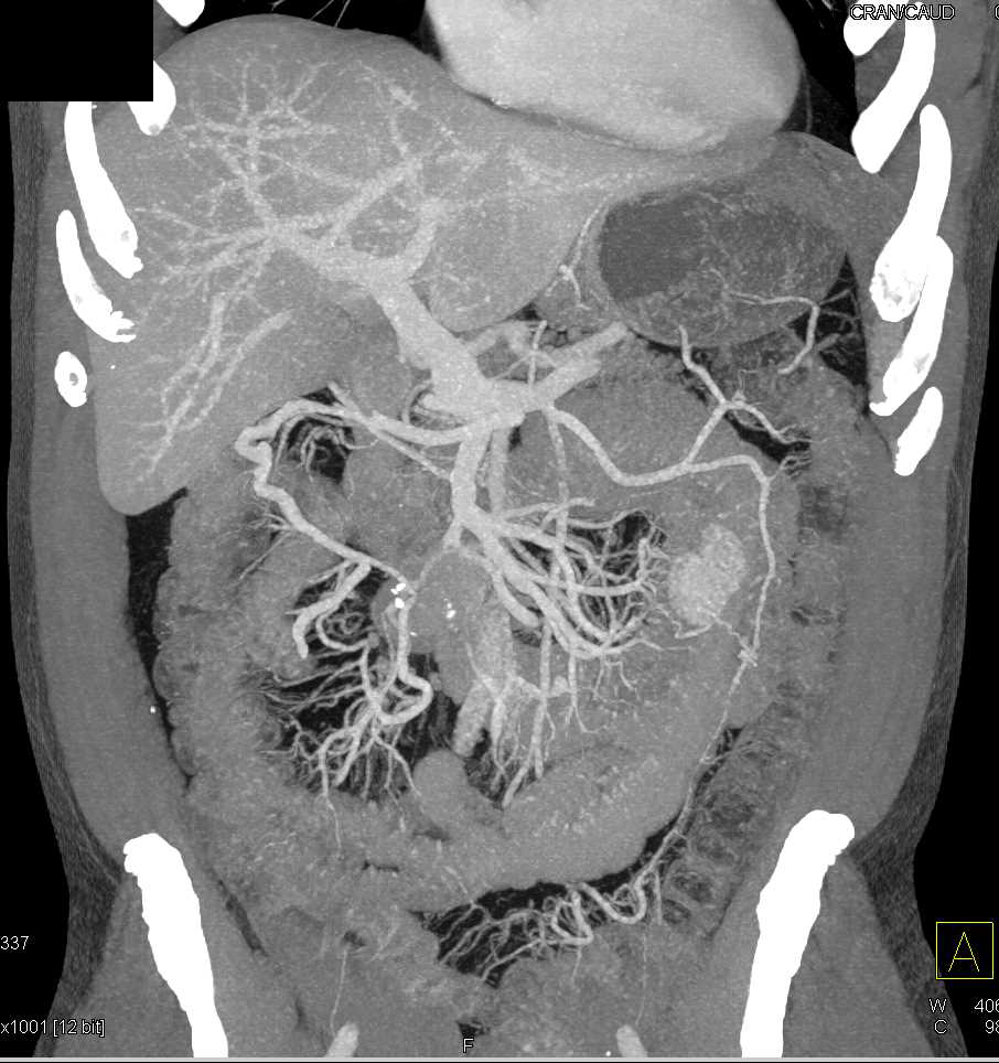 Carcinoid Tumor in the Root of the Mesentery with Liver Metastases - CTisus CT Scan