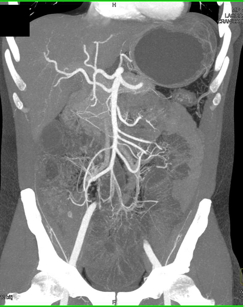 Distal Small Bowel Obstruction (SBO) due to Adhesions - CTisus CT Scan