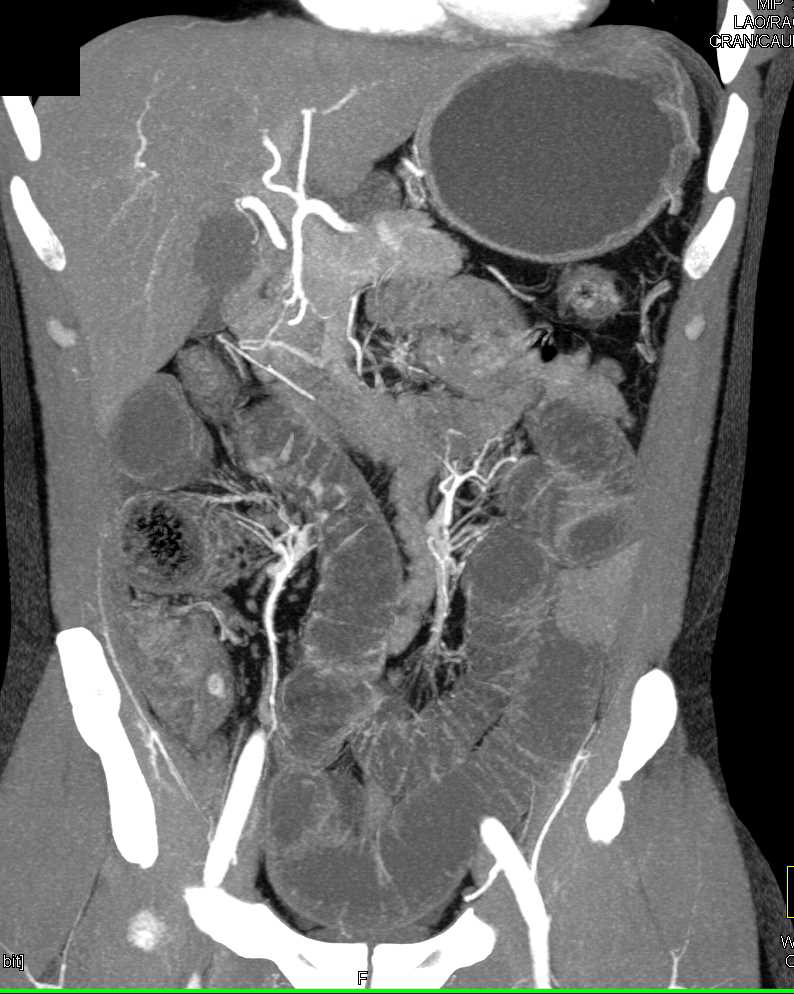 Small Bowel Obstruction (SBO) due to Adhesions - CTisus CT Scan