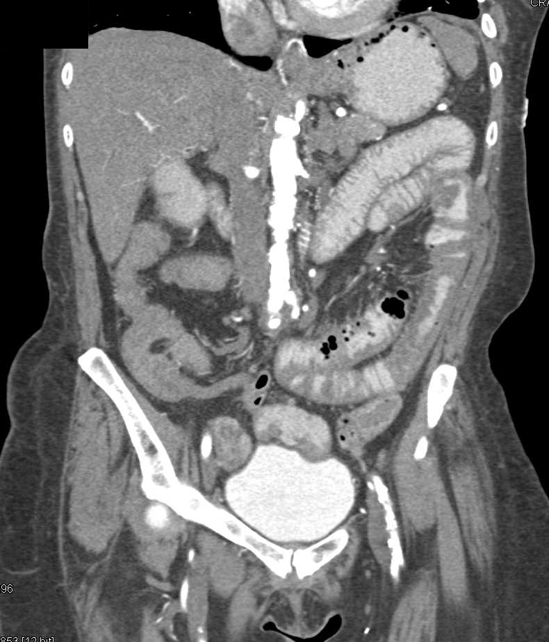 Thickened Small Bowel with Failed Stent - CTisus CT Scan