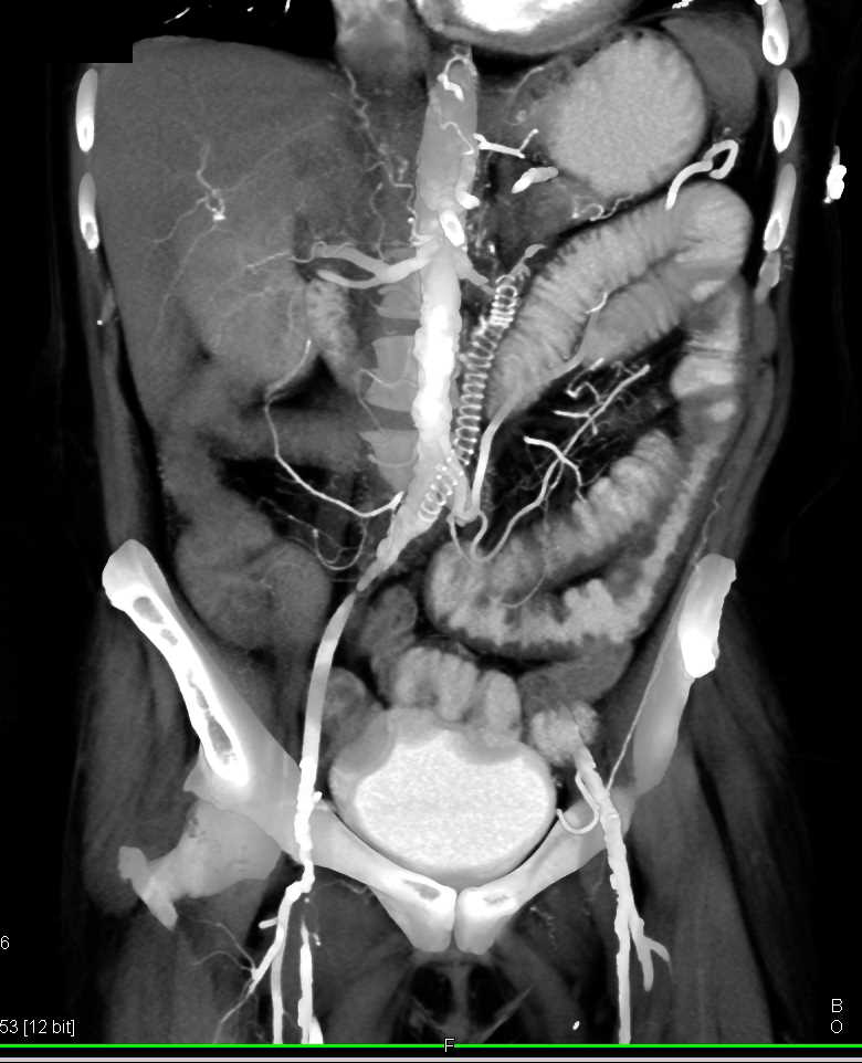 Thickened Small Bowel with Failed Stent - CTisus CT Scan