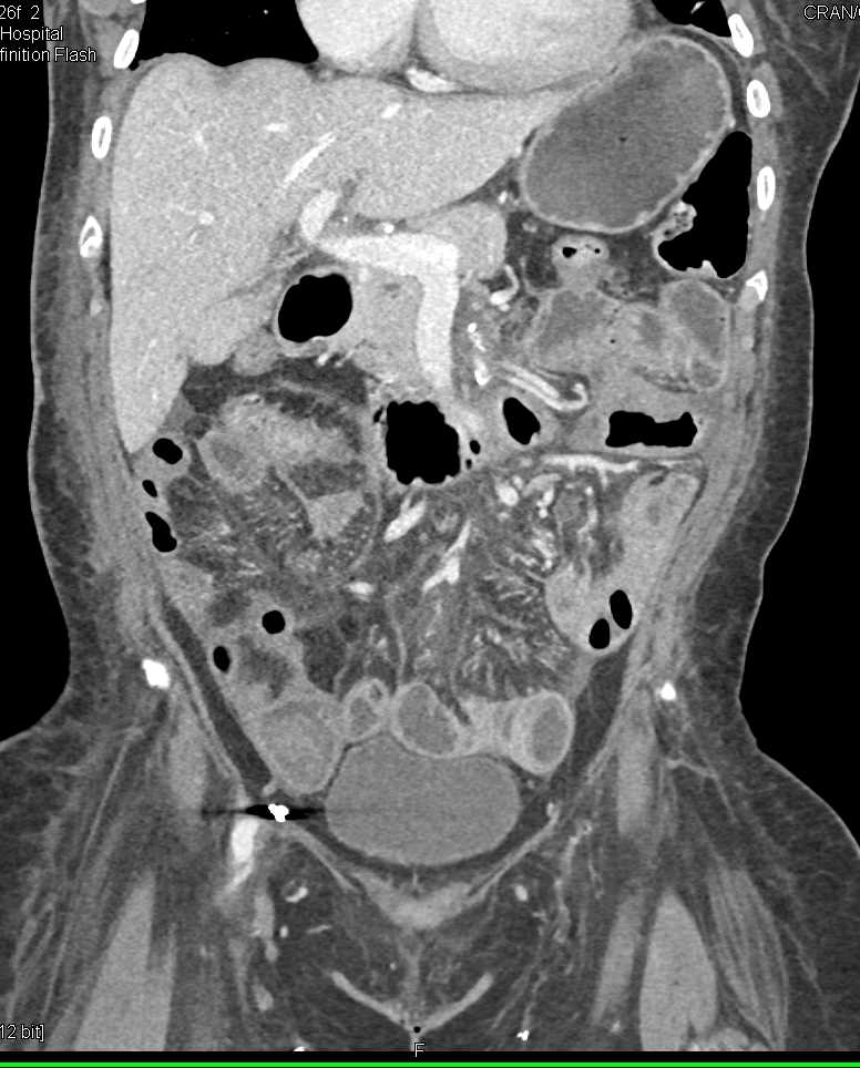 Thickened Small Bowel with Failed Stent - CTisus CT Scan