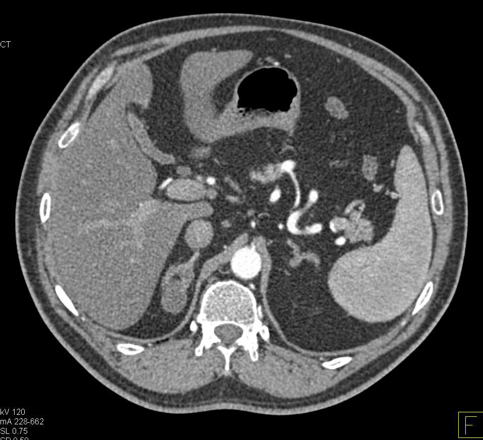 Duodenal Lipoma - CTisus CT Scan