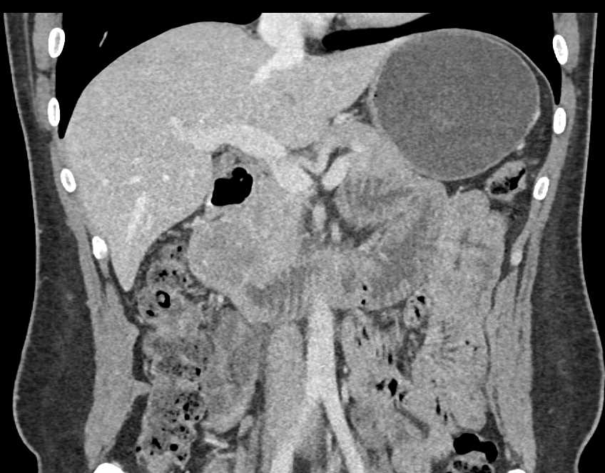 Duodenal Adenocarcinoma Simulates a Pancreatic Adenocarcinoma - CTisus CT Scan