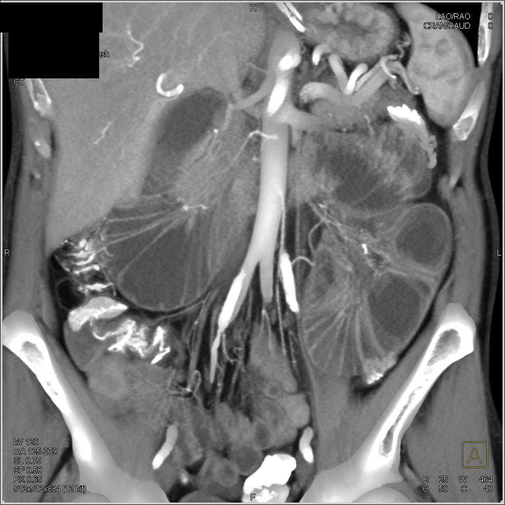 Thickening Around the Superior Mesenteric Artery (SMA) with Small Bowel Obstruction (SBO) - CTisus CT Scan