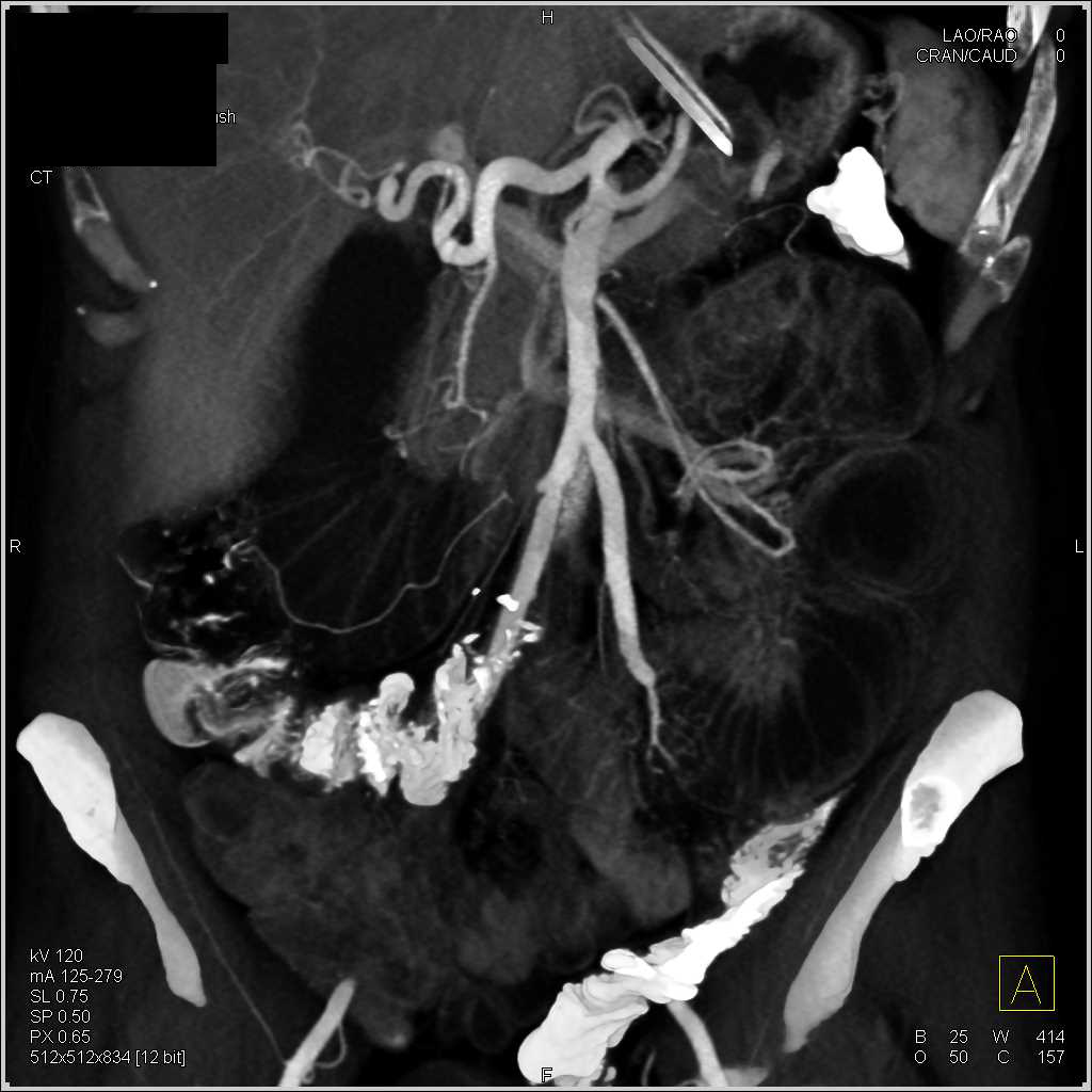 Thickening Around the Superior Mesenteric Artery (SMA) with Small Bowel Obstruction (SBO) - CTisus CT Scan