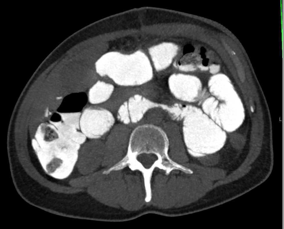 3D VRT Version of a Small Bowel Series - CTisus CT Scan