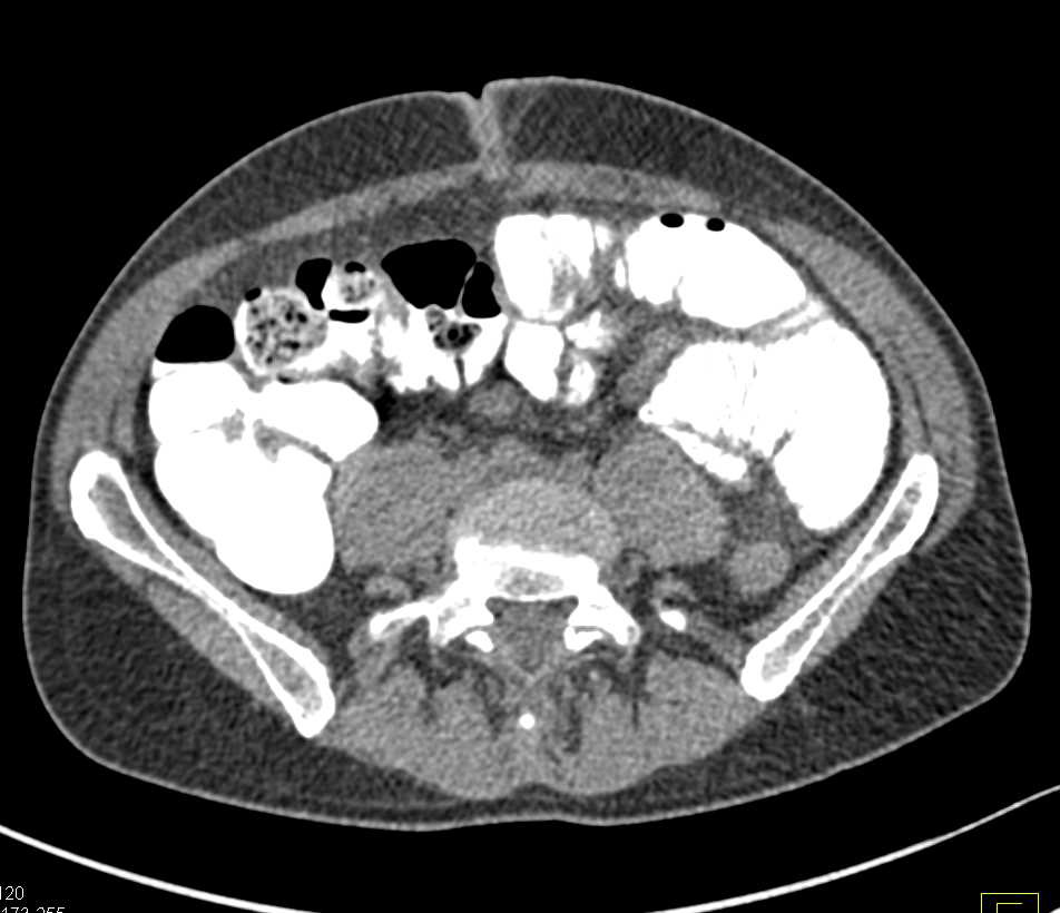 3D VRT Version of a Small Bowel Series with Stricture Near Ligament of Trietz - CTisus CT Scan