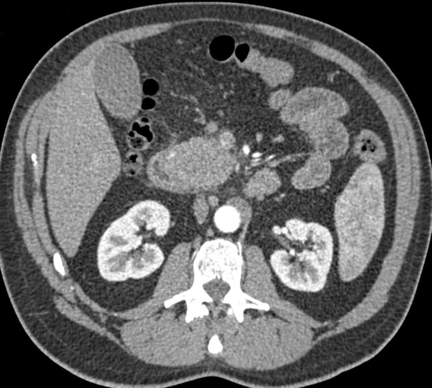 Duodenal Adenocarcinoma Simulates a Pancreatic Adenocarcinoma - CTisus CT Scan