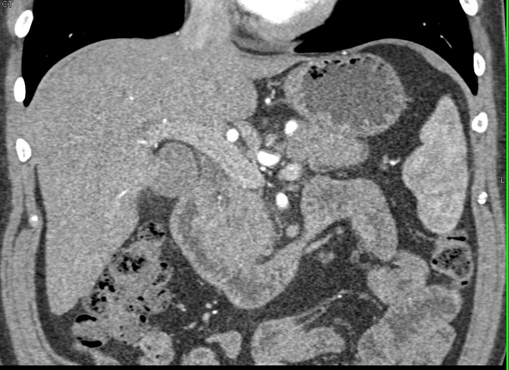 Duodenal Adenocarcinoma Simulates a Pancreatic Adenocarcinoma - CTisus CT Scan