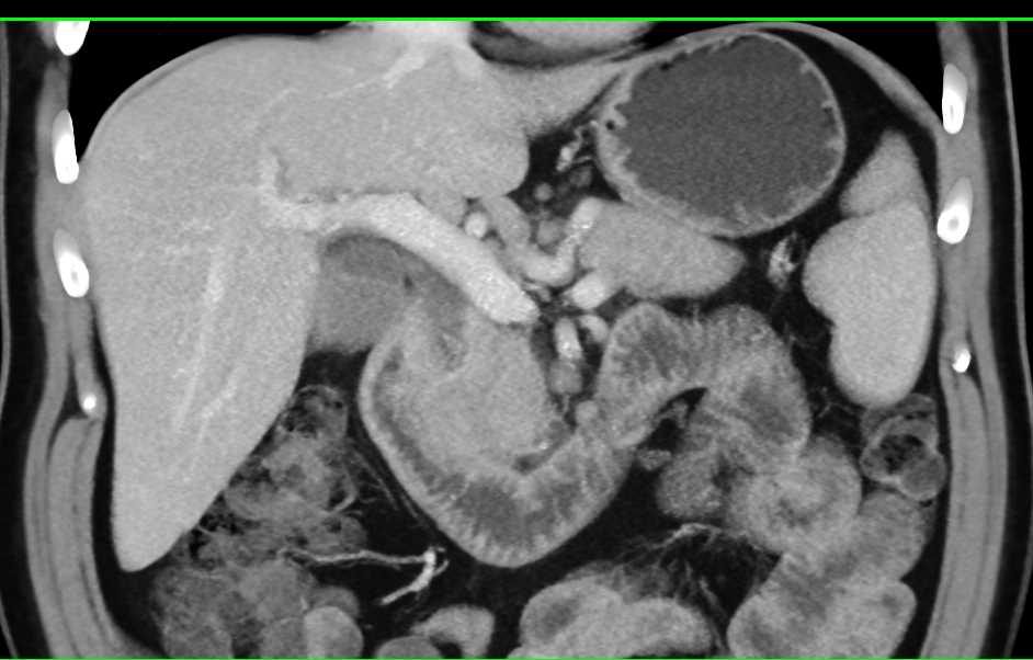 Duodenal Adenocarcinoma Simulates a Pancreatic Adenocarcinoma - CTisus CT Scan