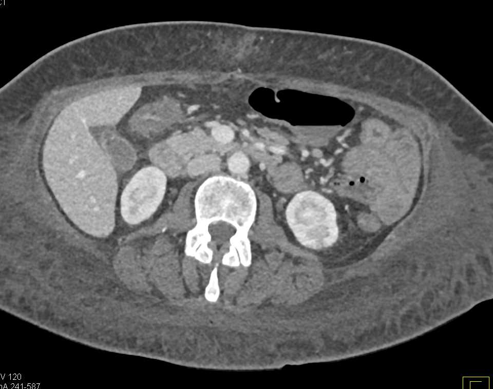Small Bowel Obstruction (SBO) due to Adhesions with Ascites - CTisus CT Scan