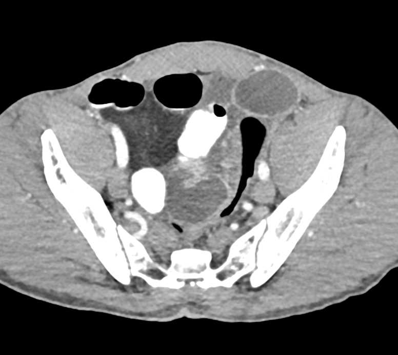 Distal Small Bowel Obstruction - CTisus CT Scan