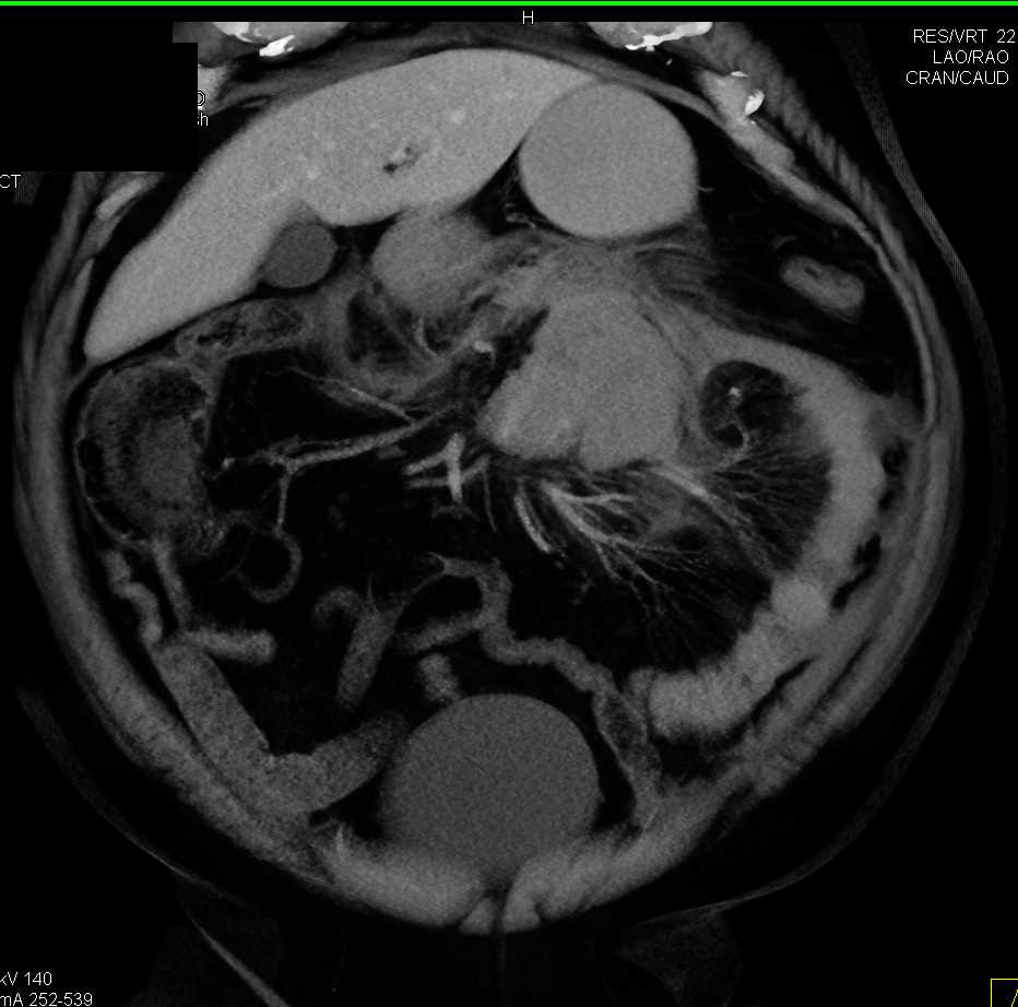 Large Bleed in the Root of the Mesentery - CTisus CT Scan