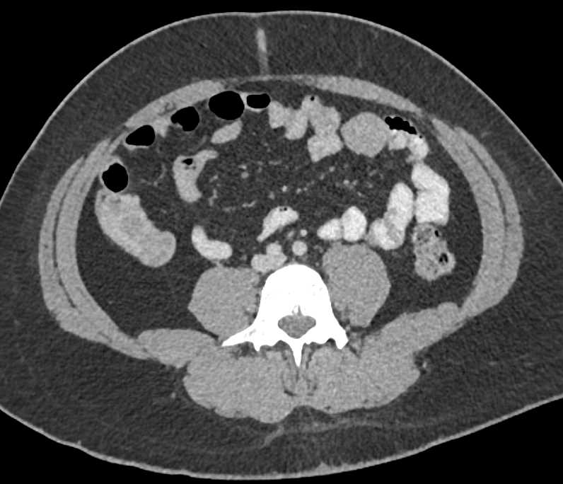 2 cm Small Bowel GIST Tumor - CTisus CT Scan